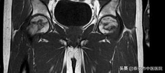 坏死的股骨头还能保得住吗？——*安泰**市中医医院脊柱外科助力患者进行股骨头坏死保髋治疗