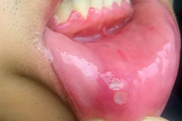 嘴起泡是排毒吗,嘴上起泡是身体在排毒吗