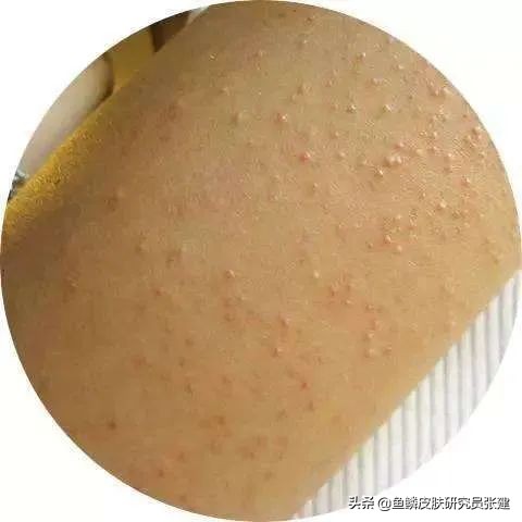 为什么气候湿润的南方也有很多鱼鳞病朋友？鱼鳞皮肤可以去南方吗