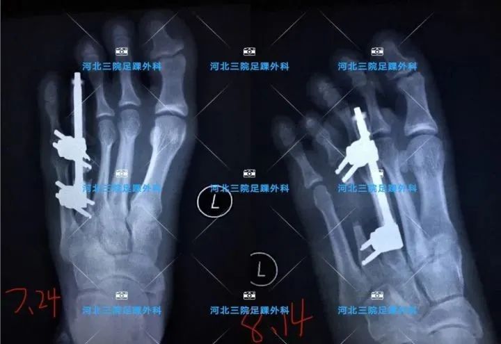 第四足趾短小怎么办,为什么第四脚趾短小