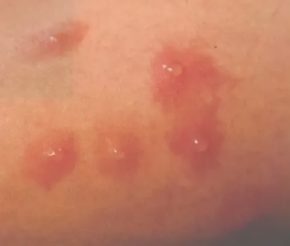 夏天到了身上起红色的小点,夏天皮肤痒起小红点