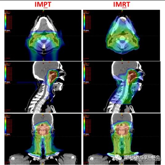 鼻咽癌复发的治愈率高吗,质子重离子治疗鼻咽癌3期