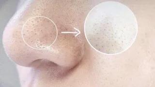 七老楠楠草莓鼻有黑头该怎么办？