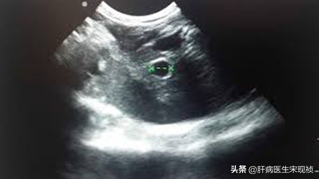 肝回声增粗是肝损伤了吗,肝回声增粗是肝硬化吗