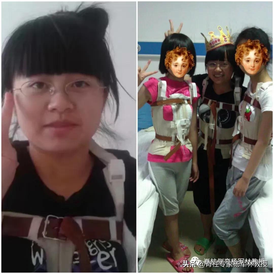 女高中生脊柱侧弯治疗视频,15岁女生脊柱侧弯能自愈吗