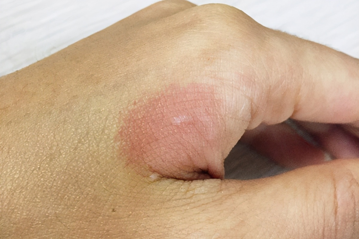 换季脸部起皮泛红用什么水,一到换季脸就脱皮是怎么回事