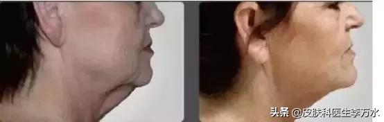 张雨绮说超声刀就像在烤肉？！线雕和超声刀，究竟哪个更靠谱？