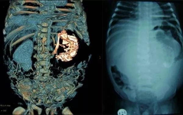 畸胎瘤为什么有毛骨头,51岁女子肚子里有畸胎瘤吗