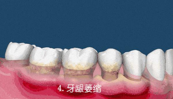 智齿蛀牙痛有什么有效方法止痛,智齿旁边牙松动蛀牙如何处理