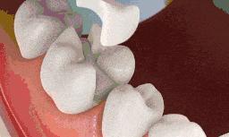 牙齿嵌体修复材料,补牙材料推荐什么品牌