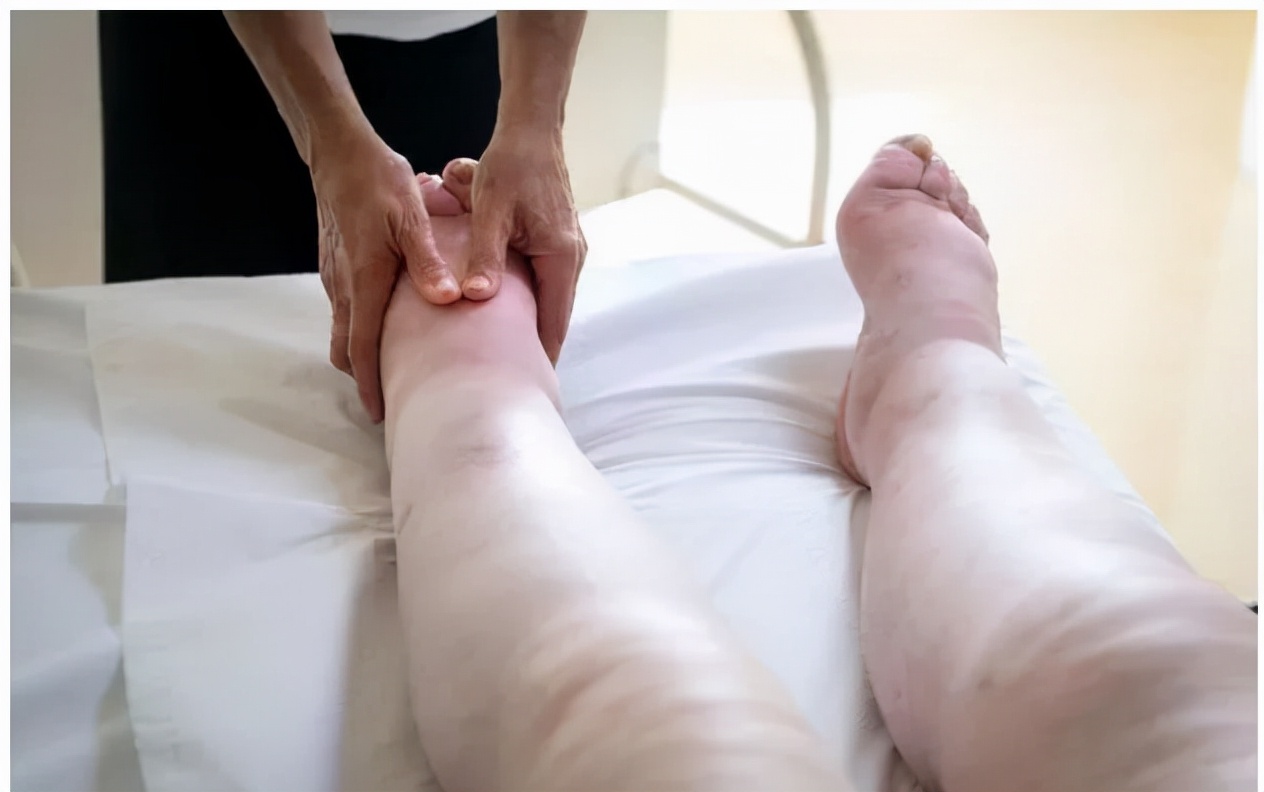 甲减是跟缺乏雌激素有关吗,甲减是身体缺少哪种元素