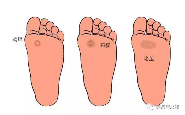 鸡眼和跖疣的区别有哪些,脚底鸡眼和跖疣的区别