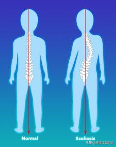 最常见的脊柱侧弯，这样运动治疗，效果明显