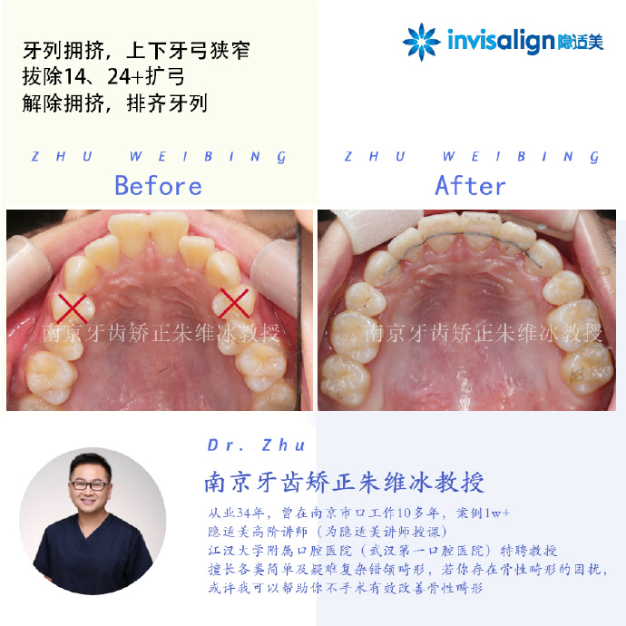 口腔正畸隐适美隐形矫治技术,隐适美深覆合矫正