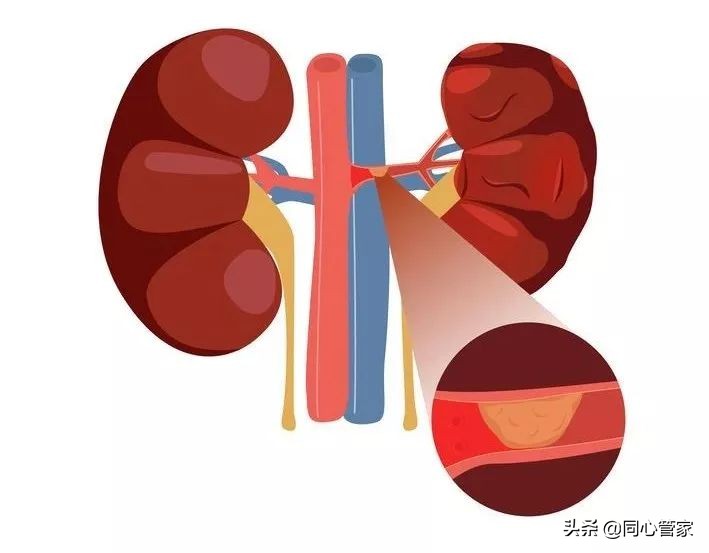 血管狭窄如何扼住生命的咽喉?让你全身器官都遭殃
