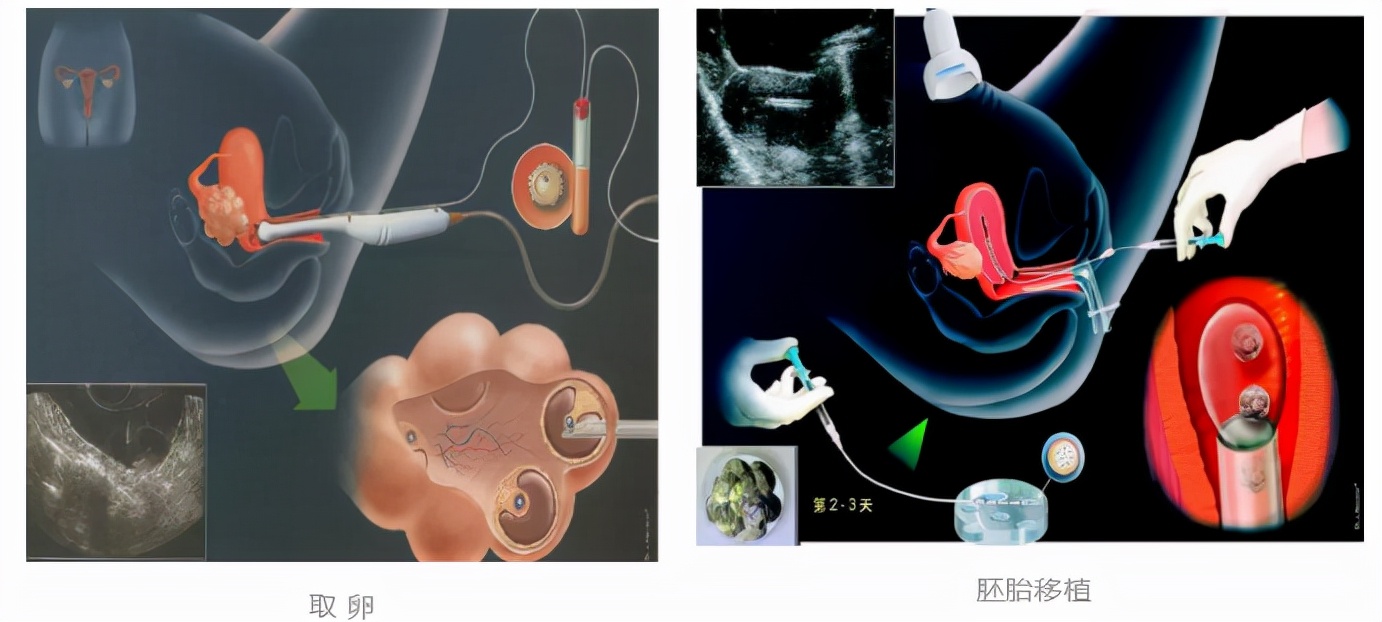 做了三次试管都没成功还可以做吗,做三代试管要很多精子吗