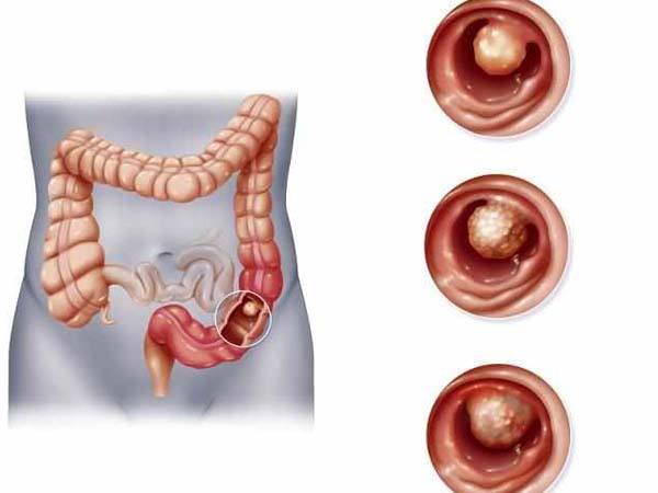 阑尾切除史的人容易得结肠癌,阑尾切除会得肠癌吗
