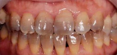 牙齿变黑是口腔癌吗,牙齿变黑了是蛀牙吗