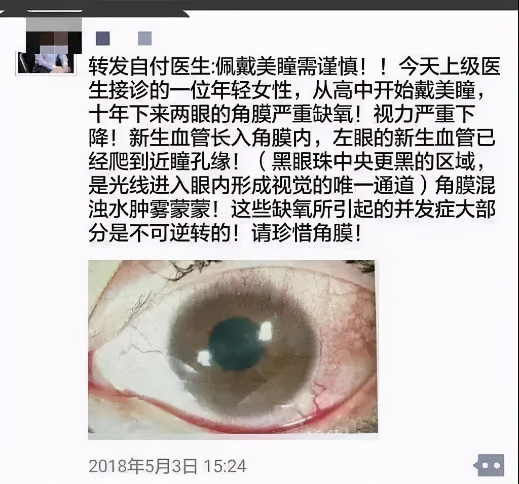 喜欢戴美瞳但是眼睛不舒服,喜欢戴美瞳还要去做近视眼手术吗