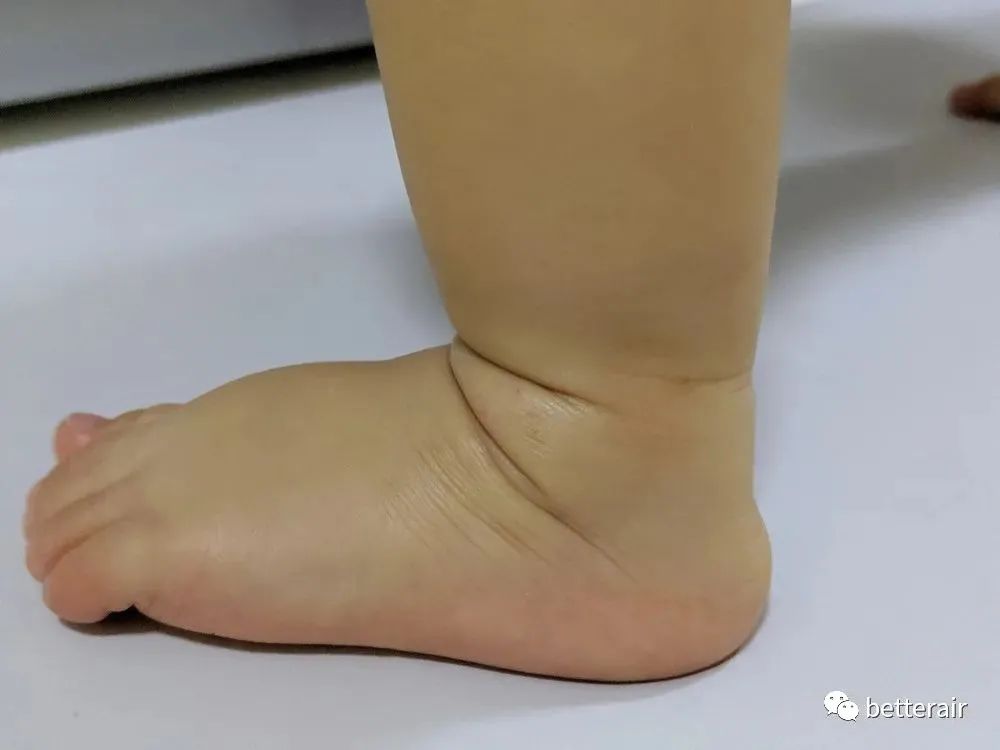 宝宝湿疹咳嗽流涕减轻,宝宝湿疹反复奇痒难忍