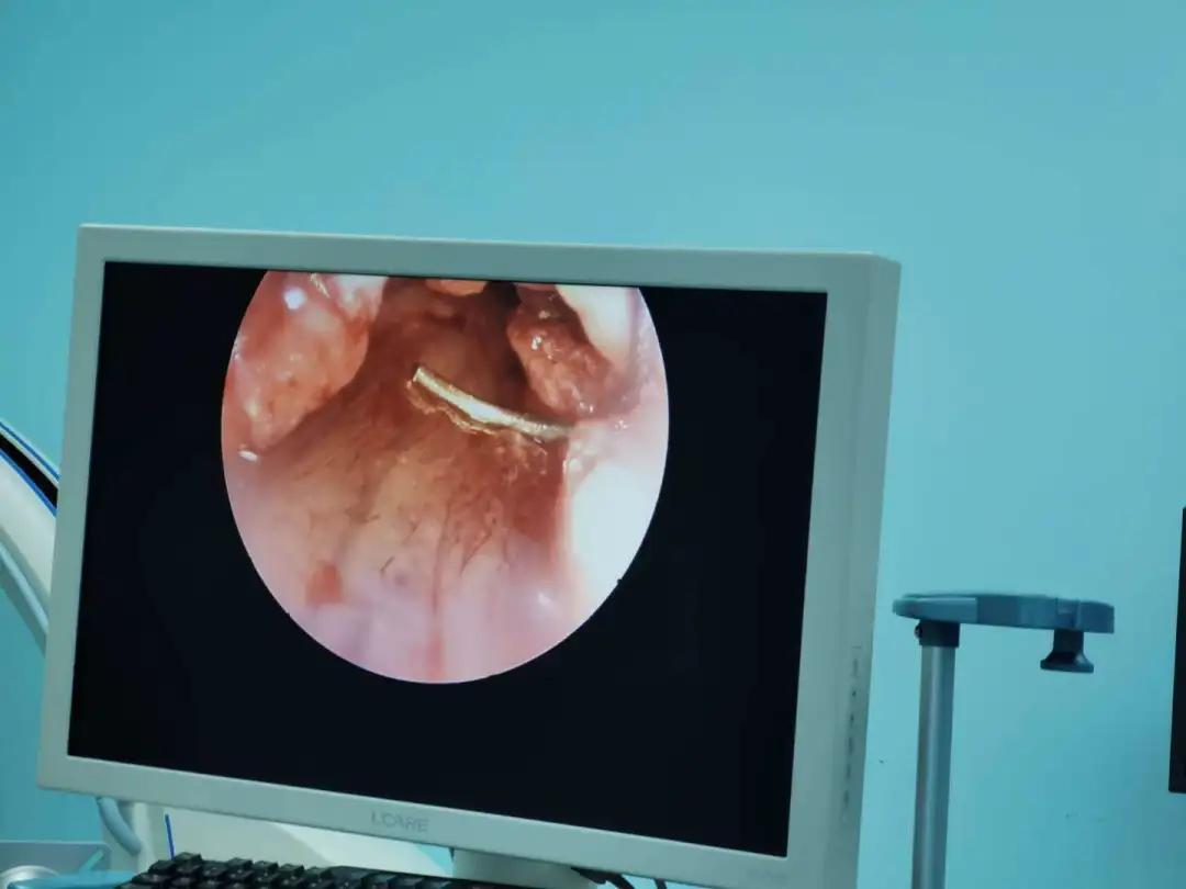 女子出现手麻，拖延1年后就医，手掌这地方已“瘪”掉！​年轻人易中招