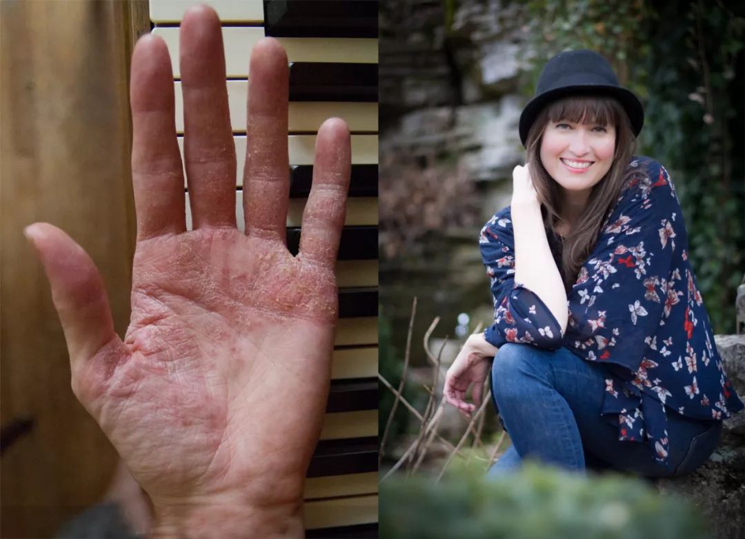 念珠菌怎么预防,如何防治念珠菌