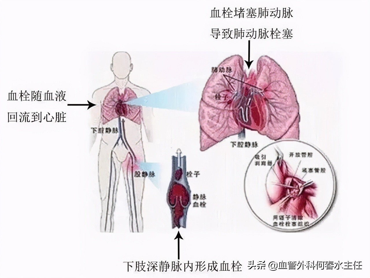 静脉曲张腿脚不好？治疗有“门路”