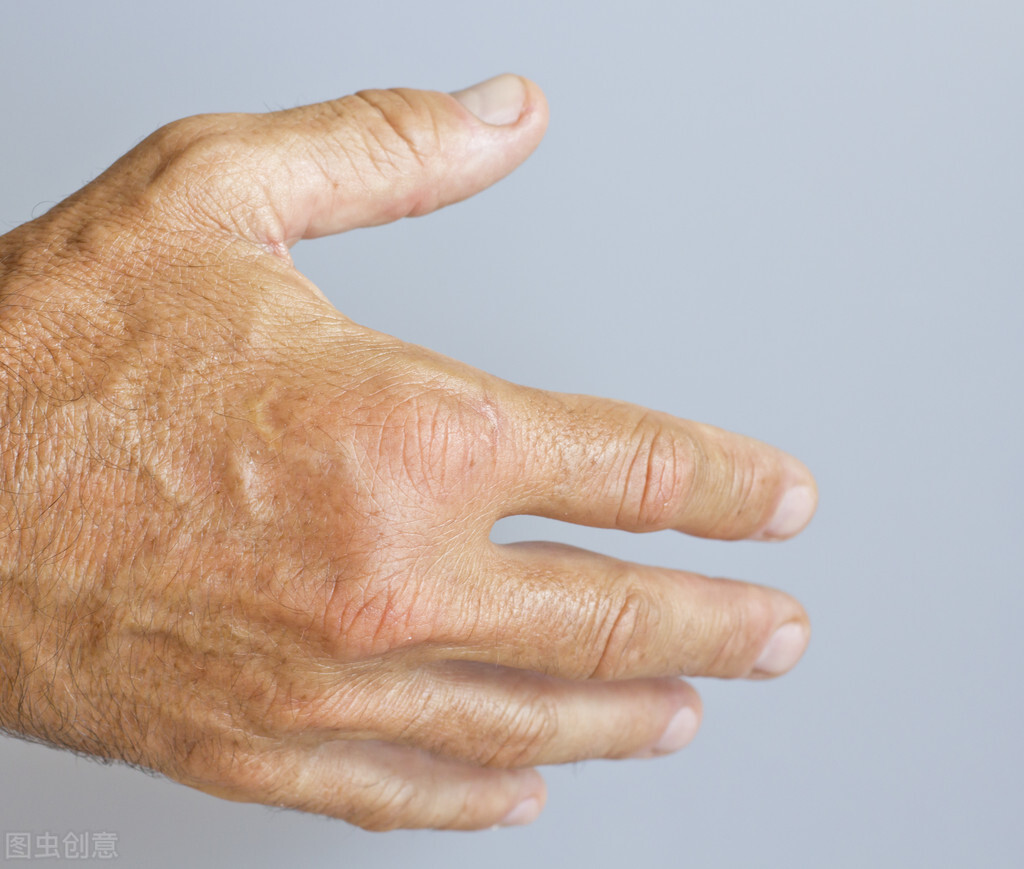 类风湿性手指肿如何消肿,类风湿手指肿了外敷药