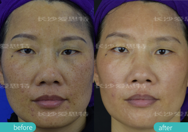 青褐斑激光治疗后颜色会加深吗,激光可以淡化褐斑吗