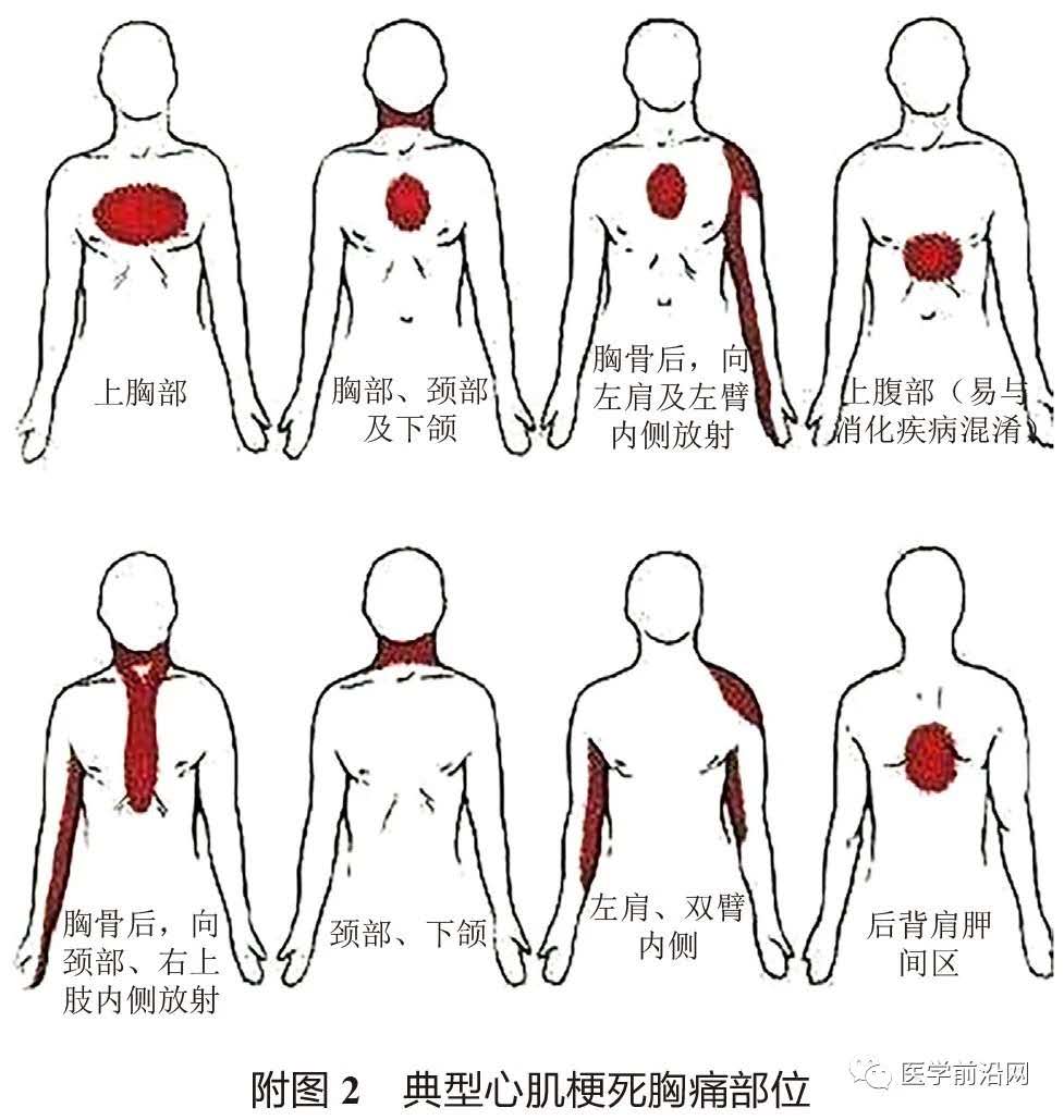 st抬高型心肌梗死溶栓时护理,急性st段抬高型心肌梗死治疗措施