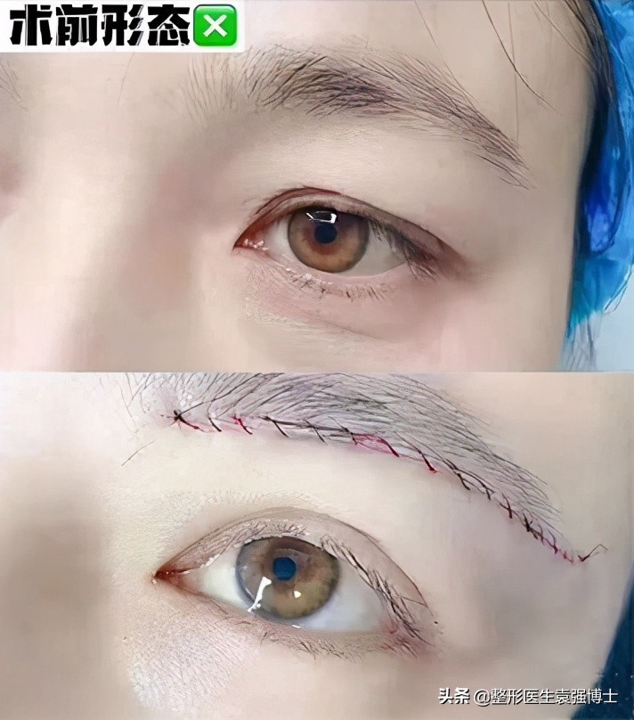 上眼皮松弛的解决办法,眼皮松了变成三角眼怎么解决