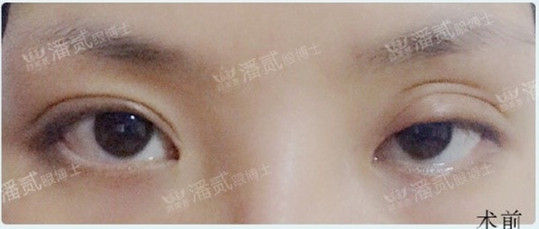 全切双眼皮提肌失败还能修复吗,什么是失败的双眼皮