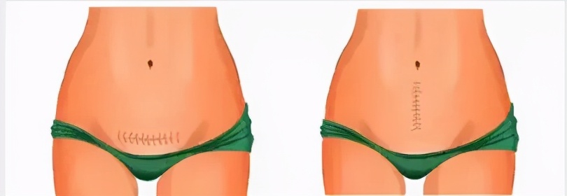 小S三次剖腹产：一胎最疼，二胎无感，三胎最倒霉