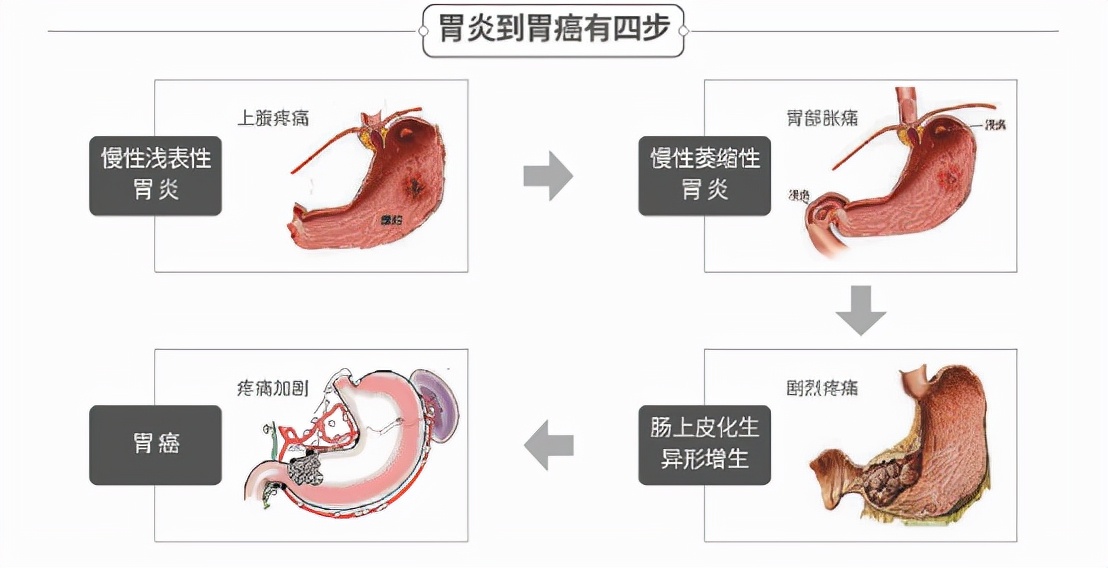 合肥有没有无痛胃镜胶囊,合肥做无痛胃镜需要多少钱