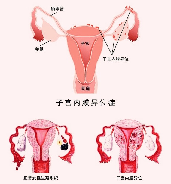 子宫内膜异位症术后,子宫内膜异位症中药
