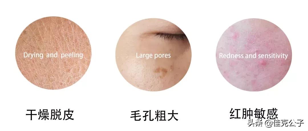 烂脸第几天最严重,烂脸修复第一步