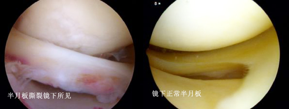 半月板撕裂手术后会有哪些症状,半月板撕裂时间长了可以做手术吗