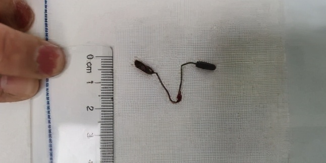 太原市第七人民医院再开新技术「双镜联合切除盆腔异物」