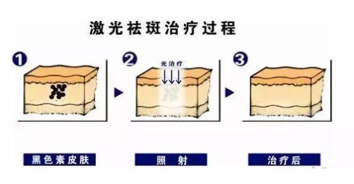 西安激光皮肤美白祛斑,激光皮秒祛斑真的有用吗