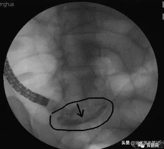 阑尾炎不开刀还有其他办法,治疗阑尾炎的最好的治愈方法