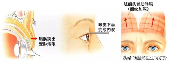 眼皮老是耷拉着睡不醒？恢复年轻其实并不难！
