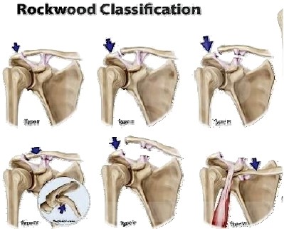 浏阳骨伤科医院髋关节脱位,肩锁关节脱位看骨伤科吗
