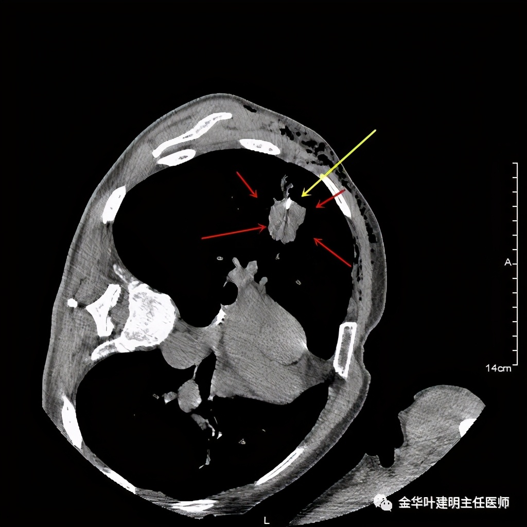 左肺占位被安排穿刺活检是肺癌吗,肺癌肺部穿刺有什么危险