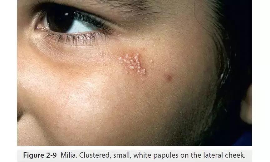 新生儿皮肤问题大全一览表,新生儿常见八大皮肤问题