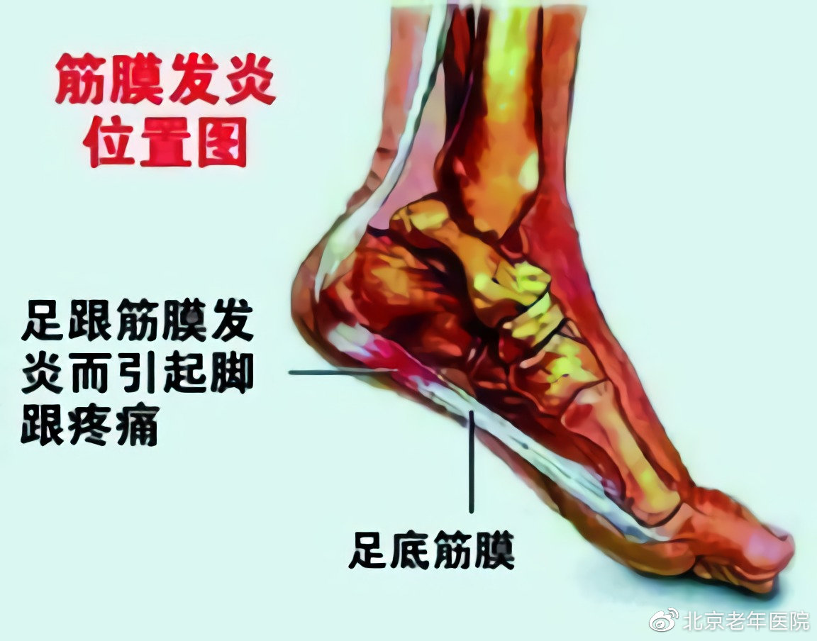 【为了您的健康，我们的专家有话说】足跟痛的黑锅不能全让骨刺来背，揪出幕后的真正元凶