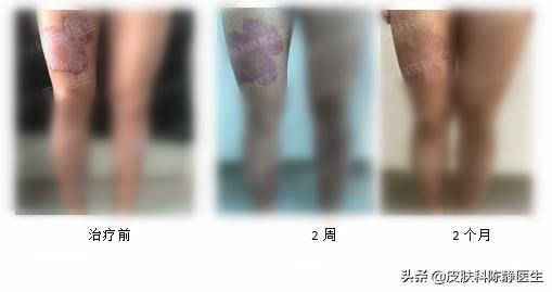 治疗牛皮癣银屑病进口生物制剂,牛皮癣最新生物制剂口服