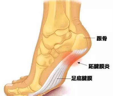 足跟痛的治疗和自我保健,专家现场治疗严重足跟痛的方法