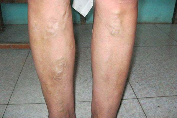 静脉曲张的表现有哪些？哪些人可能患静脉曲张呢?