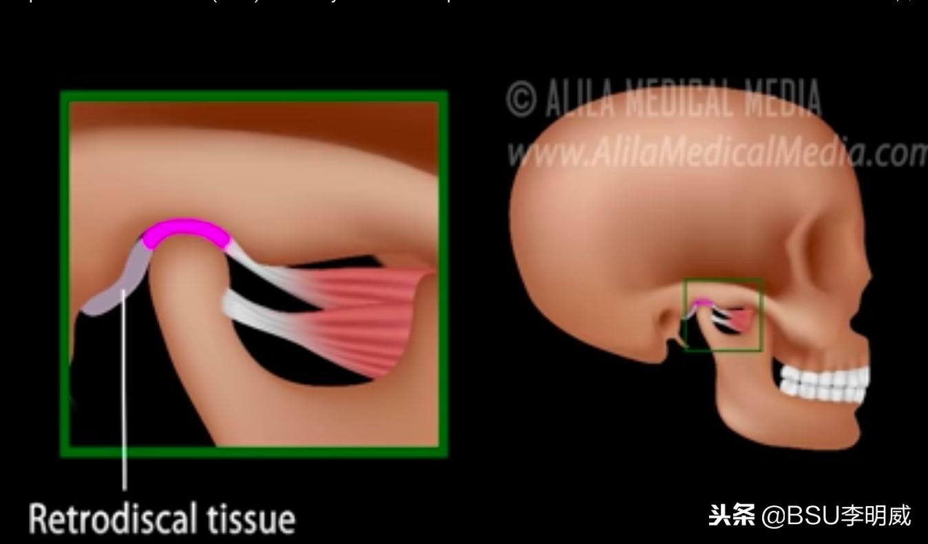 牙咬肌疼的张不开嘴怎么缓解,牙痛咬肌酸痛怎么回事