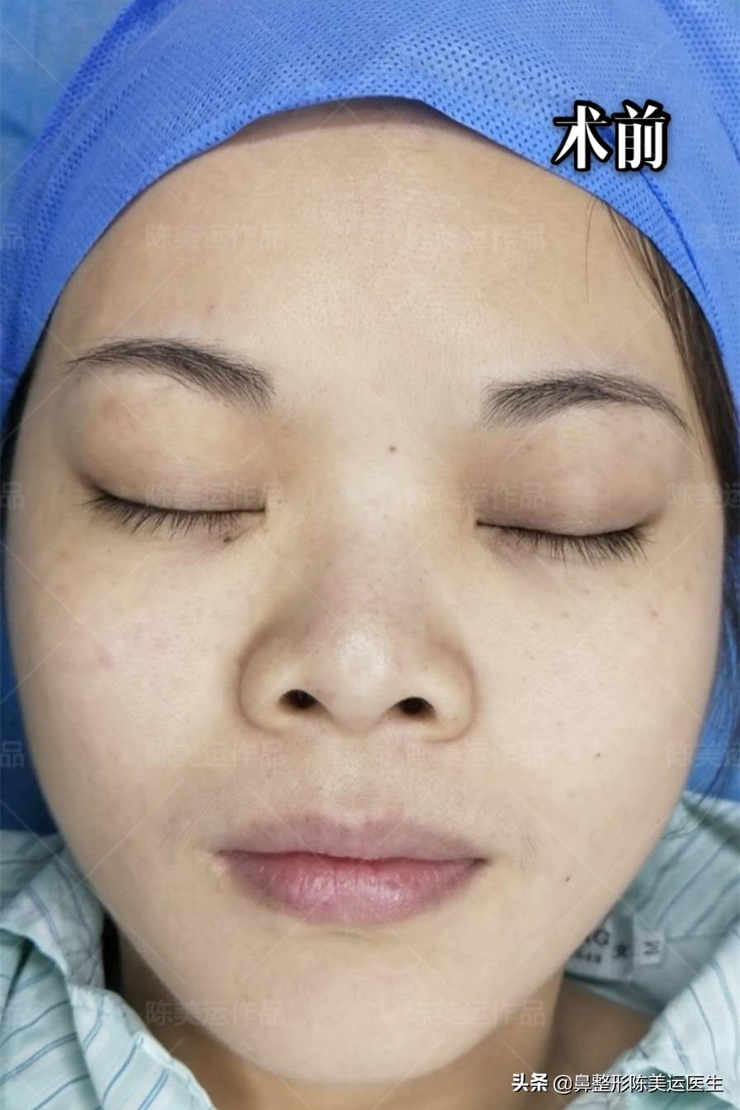 塌鼻子怎么能变成尖鼻子,鼻子太窄太小是不是很难增高鼻梁